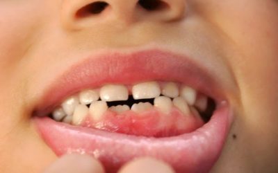 Infraocclusione dei denti decidui. Cosa vuol dire e quando si verifica?